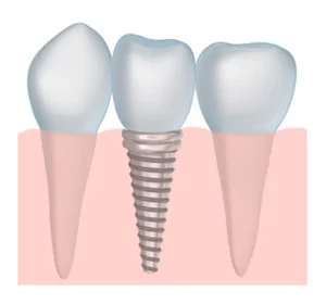 dental implants to restore smiles near Colleyville and Southlake