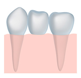 tooth crown and dental crowns in Southlake and Colleyville