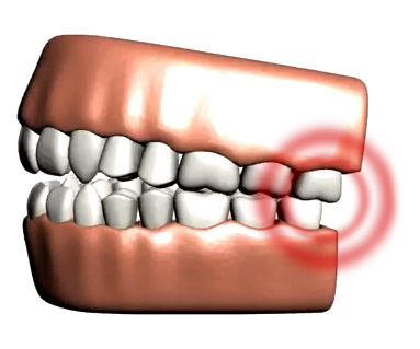 impacted wisdom teeth removal dentist near Colleyville and Southlake