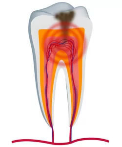 Root canal for toothache pain in Grapevine Southlake and Colleyville