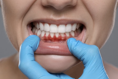gum disease