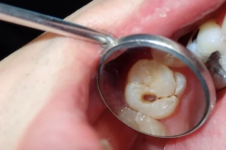 cavity