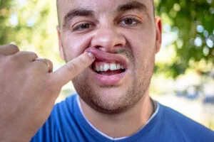 man in blue shirt exposing chipped tooth
