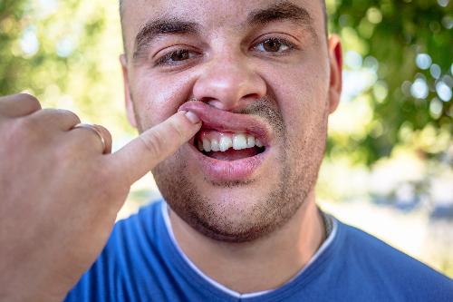 man in blue shirt exposing chipped tooth