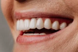 closeup of a mature woman's new veneers