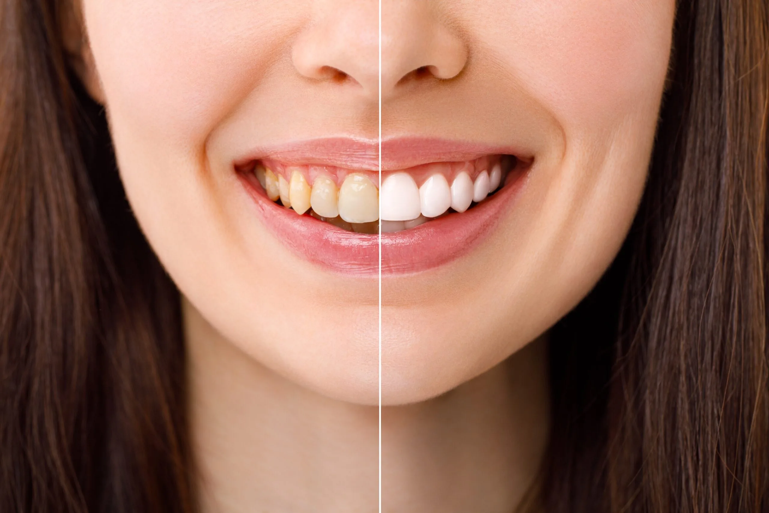 side by side of a before and after professional teeth whitening