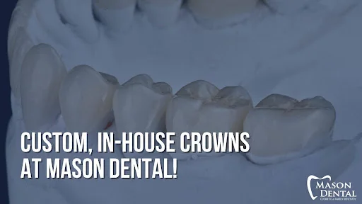 Custom In-House CEREC Crowns at Mason Dental
