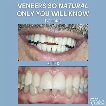 Natural porcelain veneers before and after