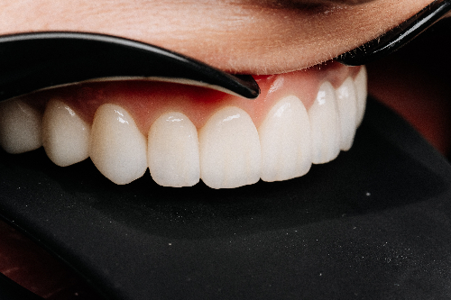 closeup dental veneer application