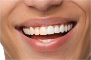 before and after, side by side of teeth whitening treatment