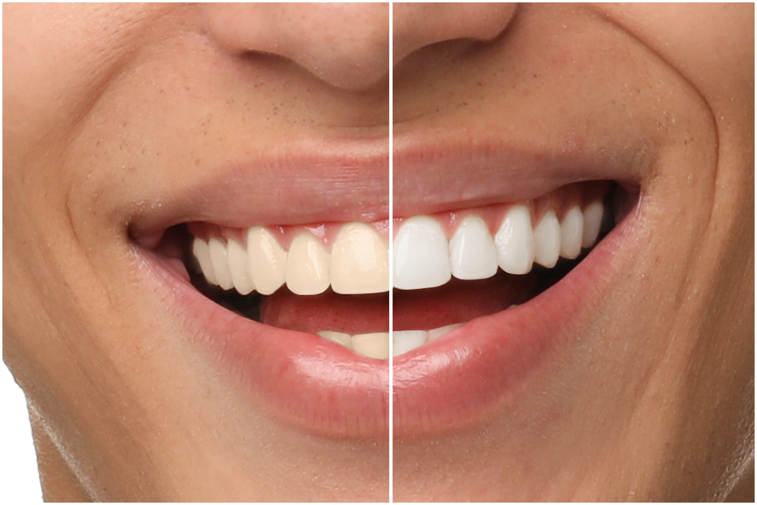 before and after, side by side of teeth whitening treatment